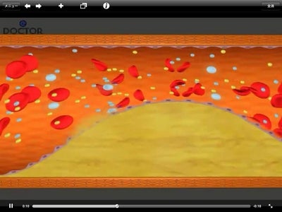 iPadアプリ【描いて消せる患者説明ボード】が4日間7千ダウンロード、医師向けアプリながら総合ランク3位～医療現場でのiPad活用の盛んさを裏付け～