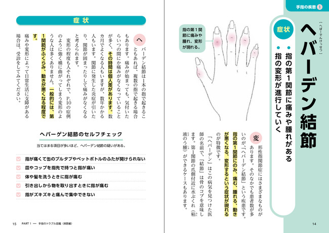 手指の疾患で代表的な「ヘバーデン結節」の例。自分の症状に該当するかどうか、まずは『セルフチェック』で確認を