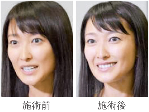 モデルB　眉施術による表情の変化