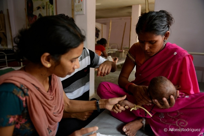 ビハール州で重度栄養失調の治療をうける子ども