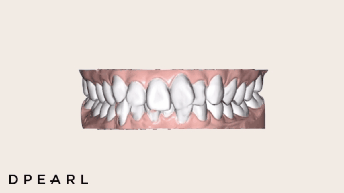 無料の歯並びスキャンを表参道で マウスピース型歯科矯正サービスdpearlが Dpearl Studio を期間限定でopen 株式会社フィルダクト のプレスリリース 無料の歯並びスキャンを表参道で マウスピース型歯科矯正サービスdpearlが Dpearl Studio を期間限定でopen 株式会社フィルダクト のプレスリリース