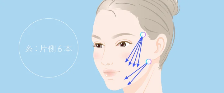 糸の挿入イメージ（片側6本の場合）