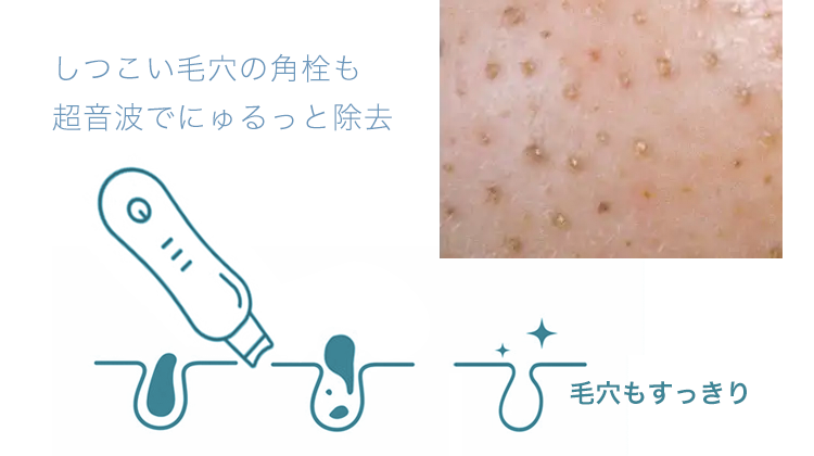 帰宅後3分で完了！本格毛穴ケア美顔器【ウォーターピーリング】で毛穴