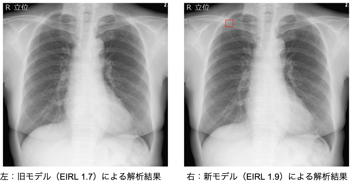 胸部x線画像から 肺がん が疑われる肺結節候補域を検出する医用画像解析ソフトウェア Eirl Chest Nodule 新モデルをリリース Lpixelのプレスリリース