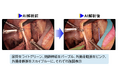 骨盤リンパ節郭清を支援する手術AIの有用性を外科医36名で実証 ―国際医学誌「npj Digital Medicine」に研究成果を発表―