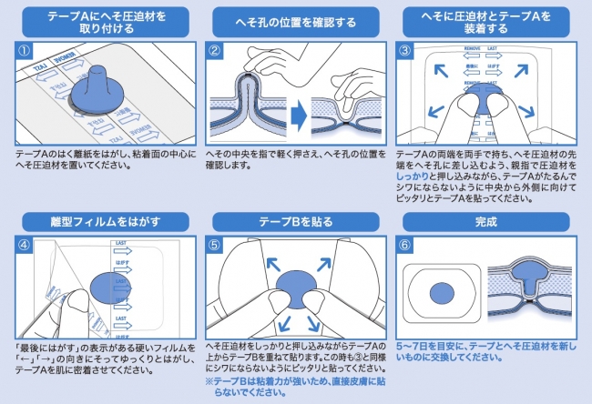 ヘルニア 赤ちゃん 臍 臍ヘルニア（でべそ）について ｜