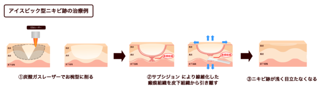アイスピック型ニキビ跡の治療例 アイスピック型ニキビ跡の治療例