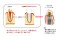 次世代バイオインプラント、FDA申請で米企業と提携