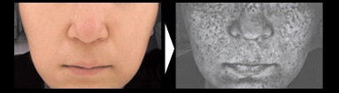 潜在シミ　左：通常写真／右：皮膚計測機器で撮影
