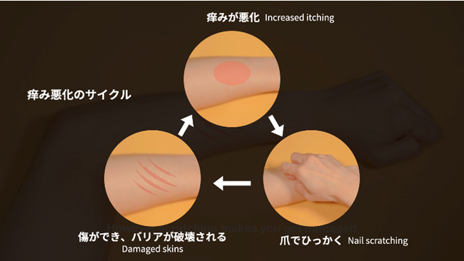 最新かゆみ緩和デバイスThermoScratch(R)を先行提供開始 企業リリース