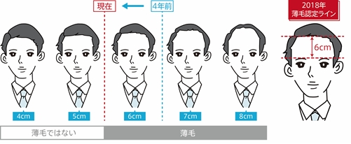 おでこの広さ何cmを越えたら薄毛 ミレニアル世代はおでこの広さ6cm以上で薄毛と認識 アンファー株式会社のプレスリリース