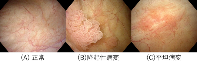 図2　膀胱内視鏡画像サンプル