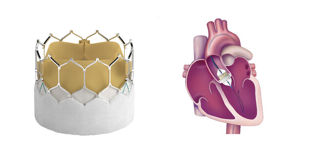 左：サピエン 3 Ultra RESILIA生体弁の写真　右：カテーテルを用い、血管から大動脈弁の位置まで人工弁を運び、バルーンを膨らませて留置する