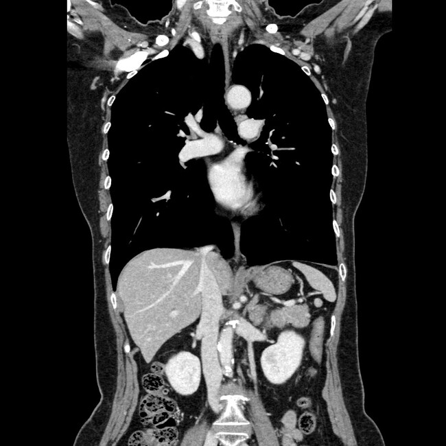 d 胸部～上腹部造影CT冠状断画像