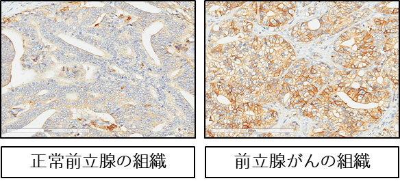 図2　正常の前立腺とがん部の 4F2hc 発現の比較。 4F2hcが発現している部分は茶色く染まる