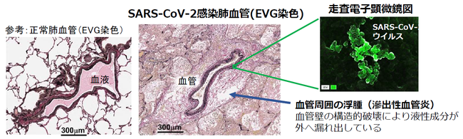 図1. COVID-19患者肺の病理学的解析 図1. COVID-19患者肺の病理学的解析
