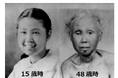 世界初!早老症ウェルナー症候群患者さんを対象とする臨床試験~ニコチンアミド リボシドが動脈硬化指標、難治性潰瘍、腎機能改善に有効