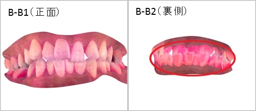 ▲歯並びの悪いBさん（染色直後）
