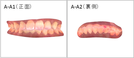▲歯並びの良いAさん（60秒後）