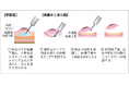 未分化型早期胃がんに対する内視鏡治療（ESD）の有効性を10年間の長期にわたる経過観察で検証～未分化型も内視鏡治療で胃の温存が可能～