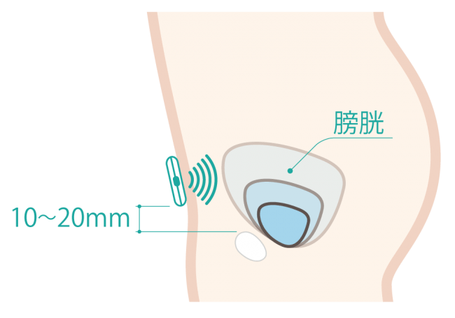 DFreeの仕組み： 下腹部にセンサー部分を装着し、超音波で膀胱の変化を捉える