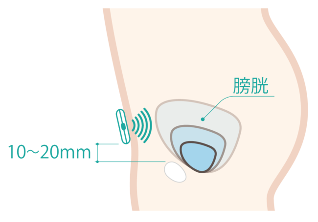 DFreeの仕組み：下腹部に装着したセンサーが膀胱の変化をモニタリングする
