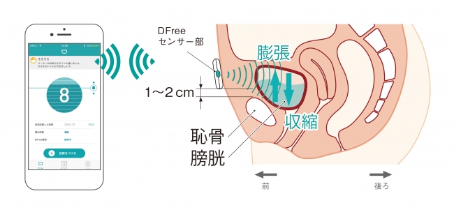 DFreeの仕組み： 下腹部に装着した本体の超音波で膀胱の変化を捉え、携帯端末にお知らせする
