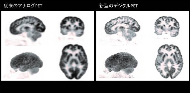 図4．アナログPET画像とデジタルPET画像の比較（同一被写体：頭頸部）