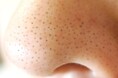 ■【秋の毛穴トラブル急増に注意】夏のダメージが押し寄せる「秋毛穴」の二大原因と対策を医師が解説！《「毛穴ケア」「毛穴レス」の美容ハック》あなたの毛穴はどれ？『毛穴タイプ別リスト』を公開｜リゼクリニック