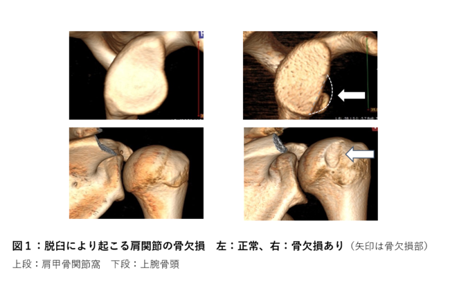 【図１】脱臼により起こる肩関節の骨欠損　左：正常、右：骨欠損あり（矢印は骨欠損部）