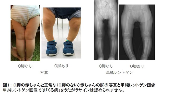 図１： O脚の赤ちゃんと正常な（O脚のない）赤ちゃんの脚の写真と単純レントゲン画像