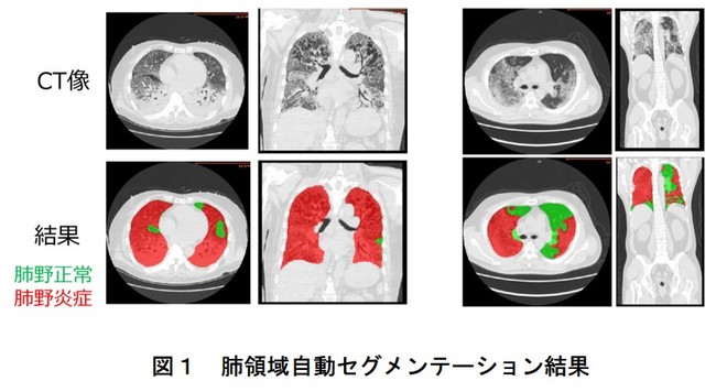 図１　肺領域自動セグメンテーション結果   