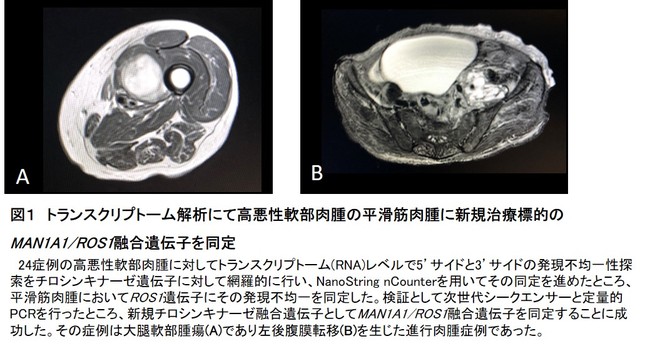 軟部肉腫の生存率