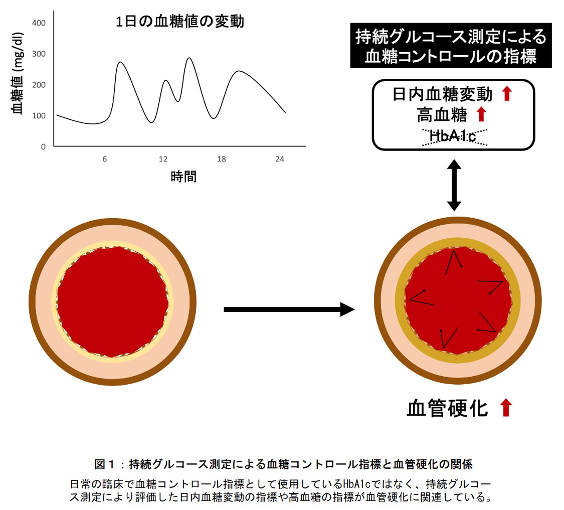 大きな血糖変動が血管硬化に関連することを明らかに 学校法人 順天堂のプレスリリース