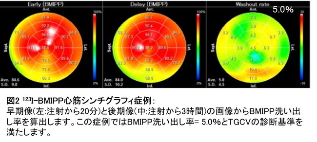 図2 : I-BMIPP心筋シンチグラフィ症例: 図2 : I-BMIPP心筋シンチグラフィ症例: