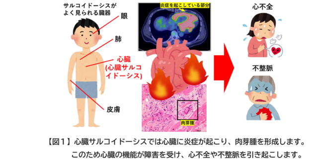 【図１】心臓サルコイドーシスでは心臓に炎症が起こり、肉芽腫を形成します。 このため心臓の機能が障害を受け、心不全や不整脈を引き起こします。