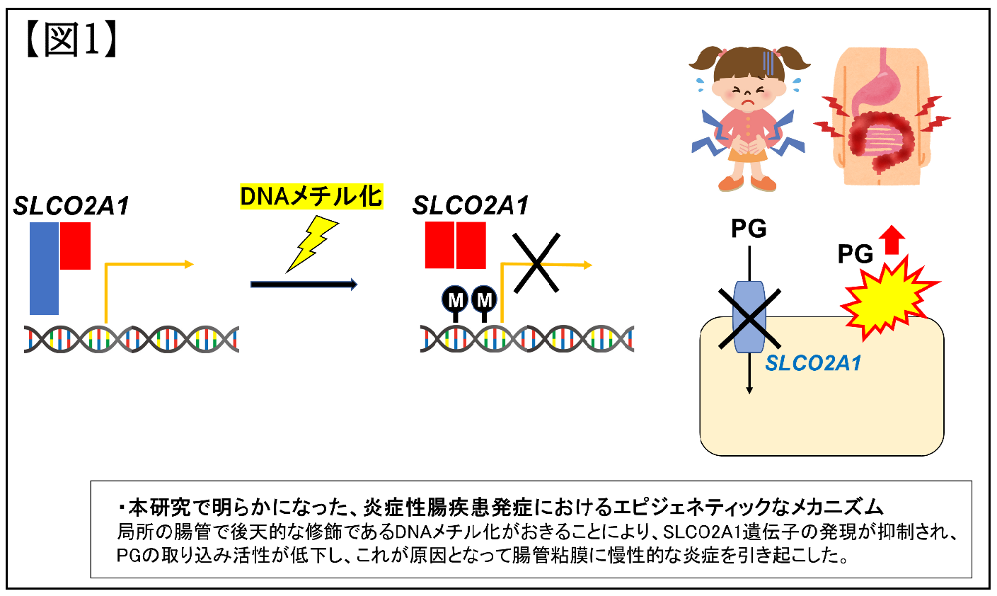 小児炎症性腸疾患の新たな原因が判明｜学校法人 順天堂のプレス