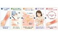 アトピー性皮膚炎患者の「触れるとかゆい」症状と相関する血液マーカーを発見