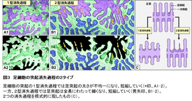 図３　足細胞の突起消失過程の２タイプ