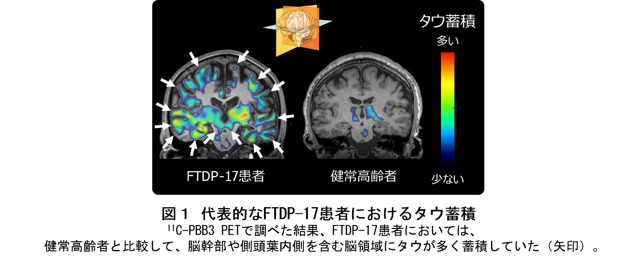 若年での発症例が多い遺伝性認知症で起こる脳内異常を解明 学校法人 順天堂のプレスリリース