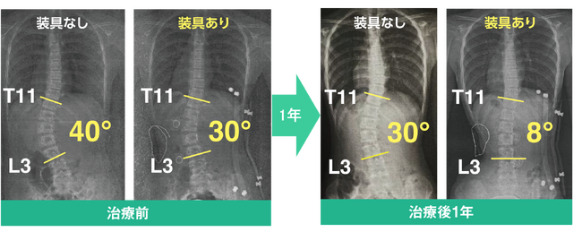 ▲本パーツを組み合わせた装具にて治療開始後の矯正効果 ▲本パーツを組み合わせた装具にて治療開始後の矯正効果