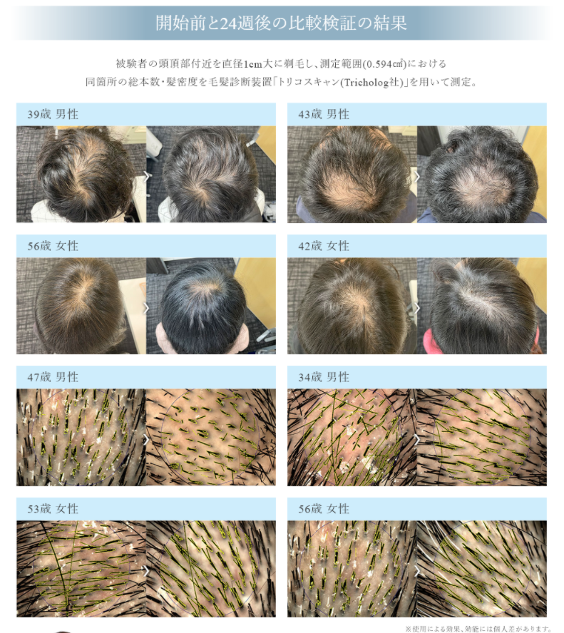 医師が開発した 栄養補給 頭皮マッサージ の発毛プログラム臨床試験で発毛効果の有効性が立証されました 株式会社pbjグループのプレスリリース 医師が開発した 栄養補給 頭皮マッサージ の発毛プログラム臨床試験で発毛効果の有効性が立証されました 株式会社pbjグループのプレスリリース