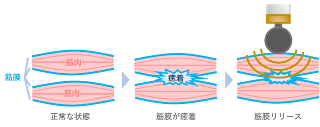 筋膜リリースでコリをケア。体をもっと軽やかに！「SYNCA（シンカ