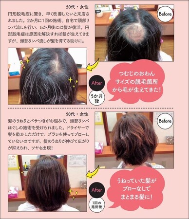 ▲「頭部リンパ流し」によるお悩み改善例。薄毛、白髪、うねりなど、さまざまな髪トラブルの改善が期待できます ▲「頭部リンパ流し」によるお悩み改善例。薄毛、白髪、うねりなど、さまざまな髪トラブルの改善が期待できます