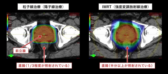 図2：IMRT（強度変調放射線治療）と「粒子線治療（陽子線治療）」の照射される線量　分布比較