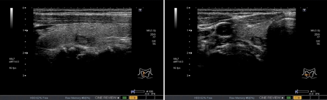 甲状腺エコー画像の例。縦断像（左）、横断像（右）、ともに中央に腫瘍がみられる