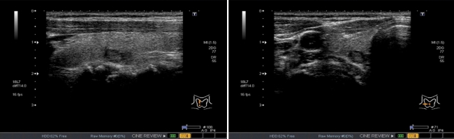 伊藤病院とインキュビット、ディープラーニング技術を用いた甲状腺腫瘍