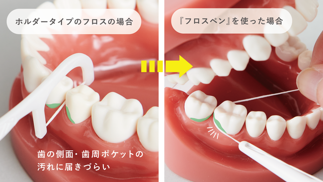 フロスはどのくらいの頻度で、いつ行うべきですか?