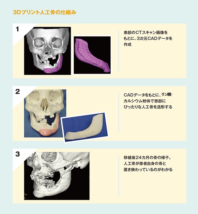 世界初 ３dプリンター成形による 患者自身の骨に癒合し 同化する人工骨 Ct Bone の承認を取得 株式会社ネクスト21のプレスリリース