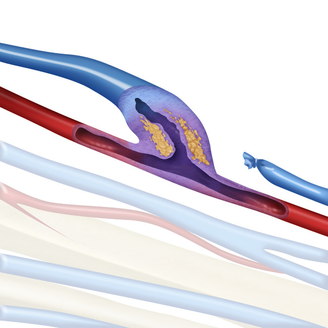 図1　人工的に動脈と静脈を吻合したシャントに起因した静脈の再狭窄部位のイメージ